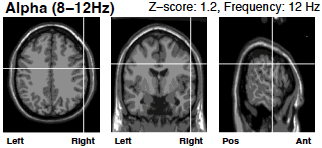 Screenshot 2024-10-28 at 3.05.05 PM alpha wave brain scan after neurofeedback